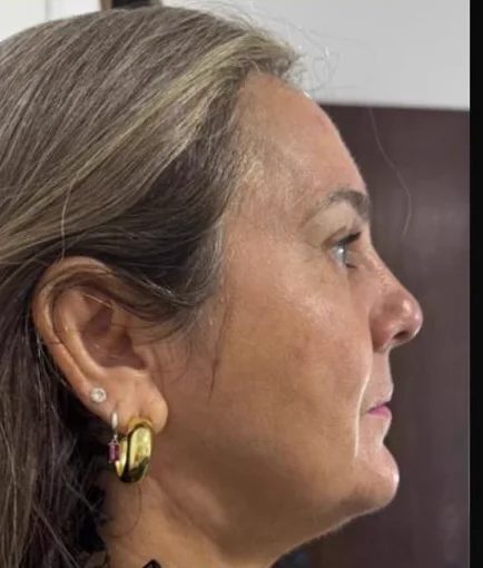 Depois do Microfocado: cliente de perfil.