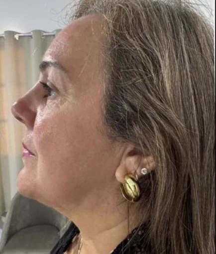 Depois do Microfocado: cliente de perfil.